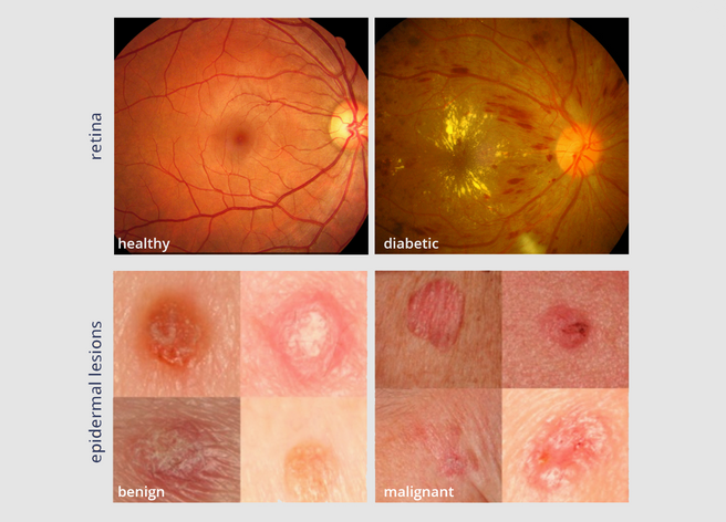 Top: Two fundus photographs. The left image is healthy while the right image shows signs of diabetic retinopathy. Bottom: Two epidermal lesion images. The left image is benign while the right image is malignant. Sources: ocutech.com & nature.com